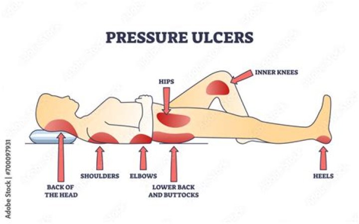 What is a pressure ulcer definition