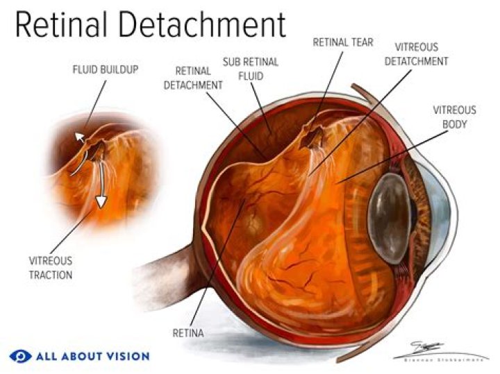 What is a retinal Operculum