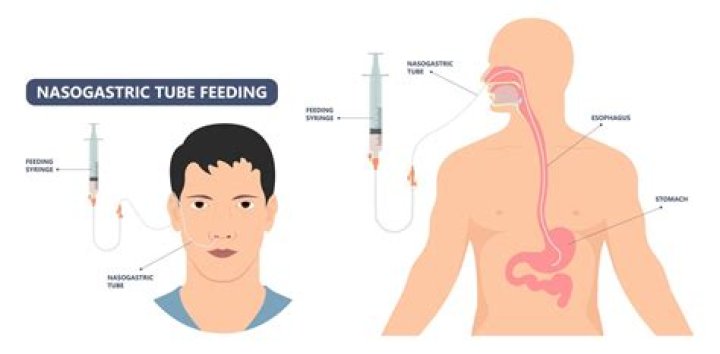 What is a Transpyloric feeding tube