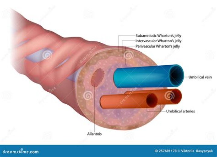What is a Trivascular umbilical cord