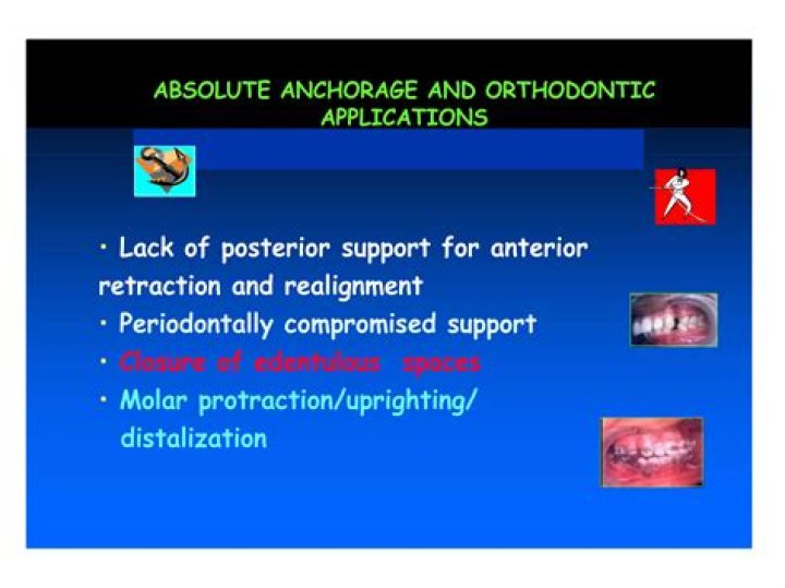 What is absolute anchorage in orthodontics