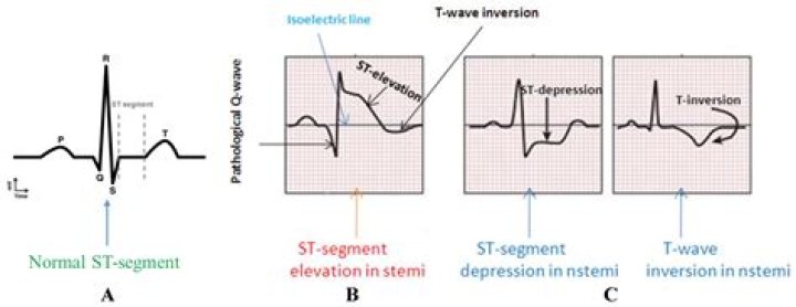 What is an Nstemi