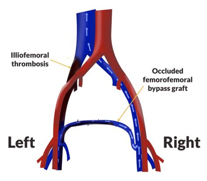 What is Aortofemoral bypass