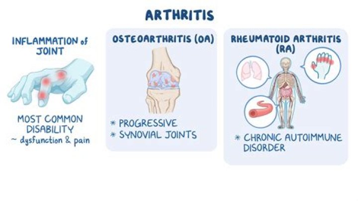 What is arthritis characterized by