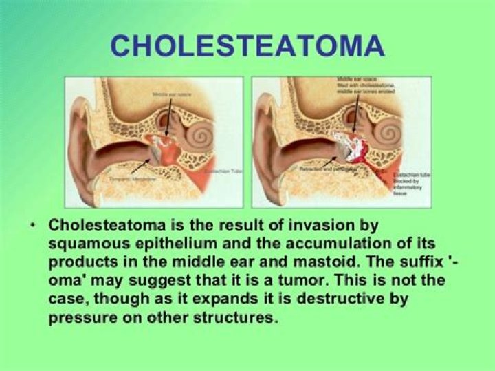 What is cholesteatoma of attic