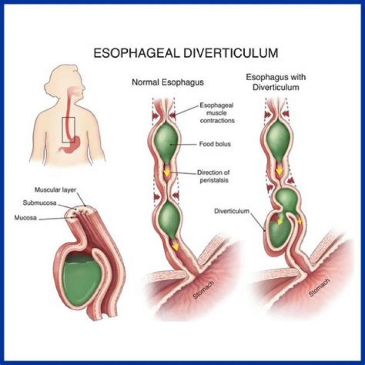 What is diverticulum of the esophagus