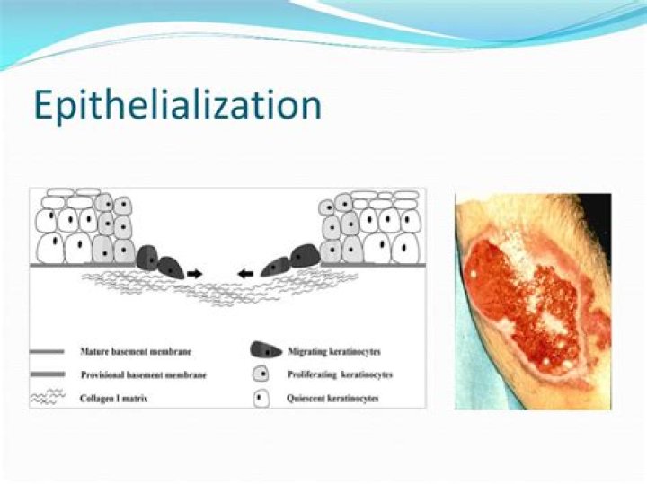What is Epithelialized tissue