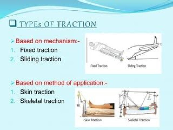 What is fixed traction
