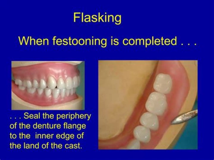 What is gingival festooning