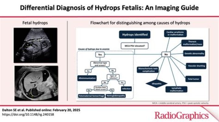 What is HDN in pregnancy