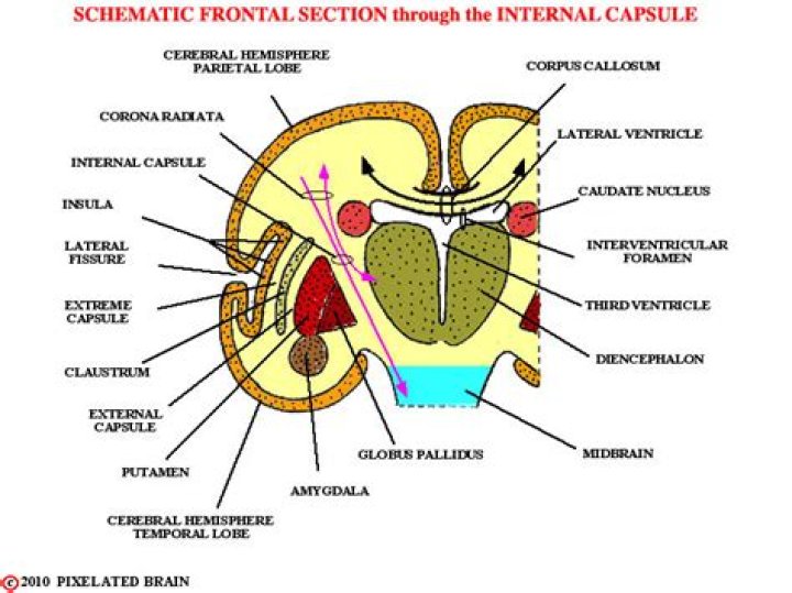 What is internal capsule stroke