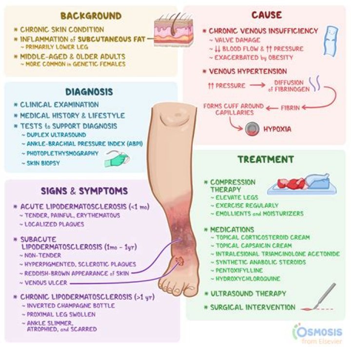 What is Lipodermatosclerosis treatment