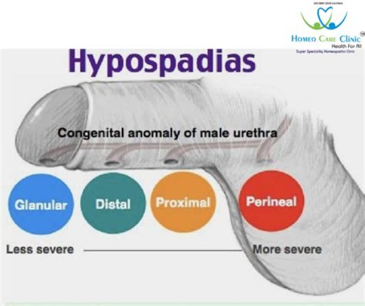 What is perineal hypospadias