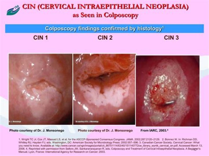 What is SCJ in colposcopy