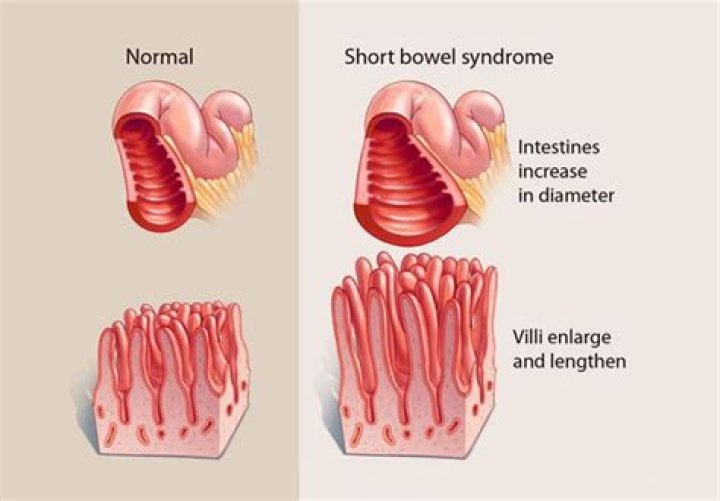 What is short bowel syndrome disease