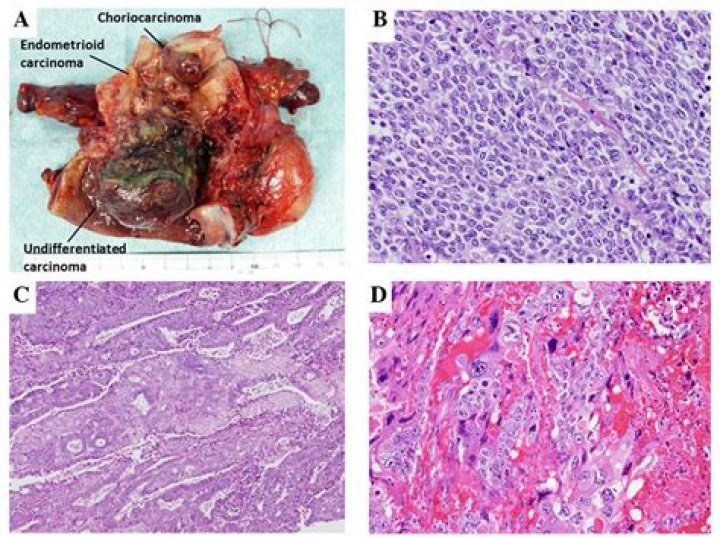 What is the choriocarcinoma