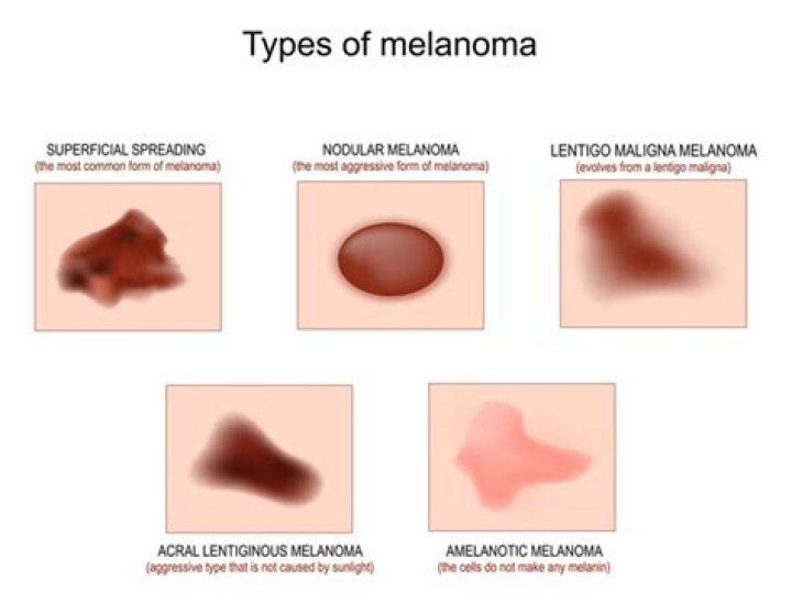 What is the difference between lentigo maligna and lentigo maligna melanoma