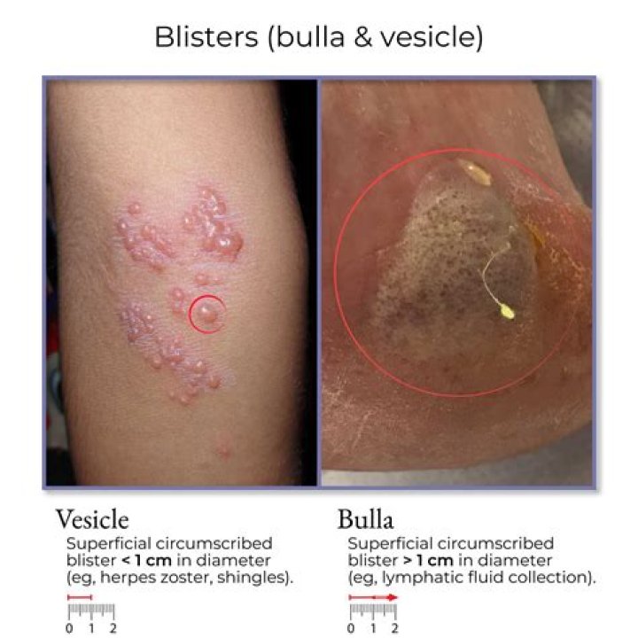 What is the difference between pustule vesicle blister and Bulla