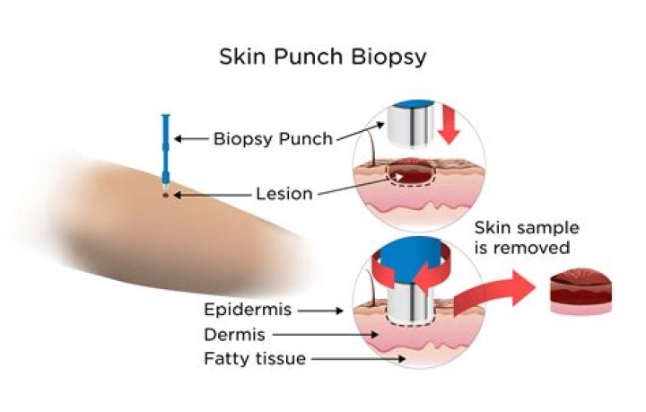 What is the process of biopsy