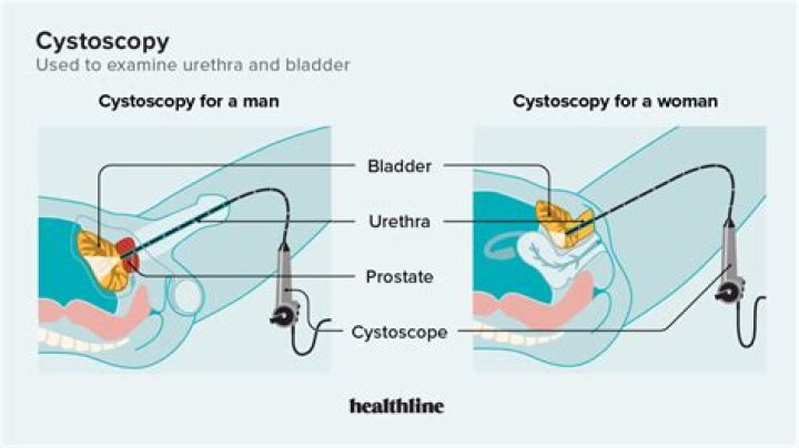 What is the purpose of the cystoscopy with bilateral retrograde pyelogram