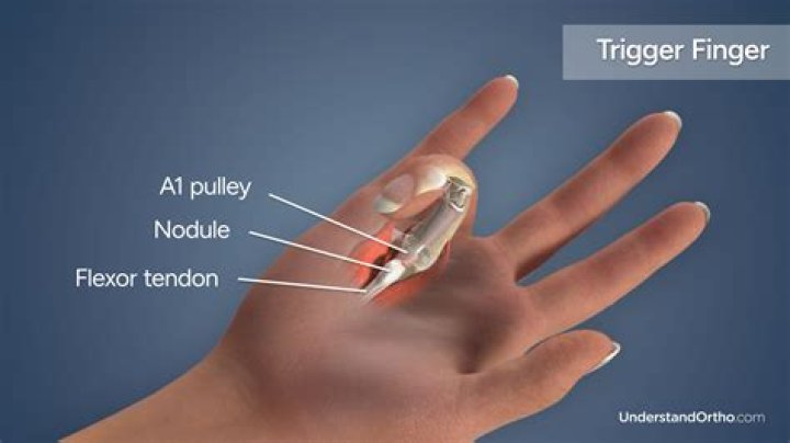 What is trigger finger ailment