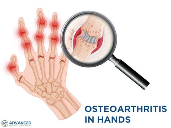 What pathology is characteristic of osteoarthritis