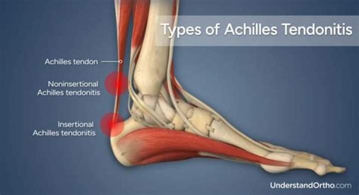 What tendon attaches to the calcaneus