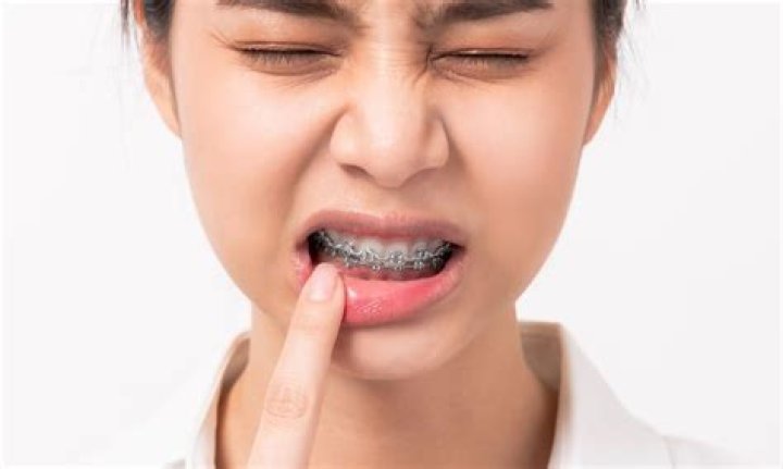 When Do Braces Stop Cutting Your Mouth