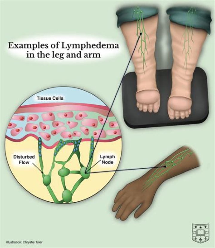 Who is most affected by lymphedema