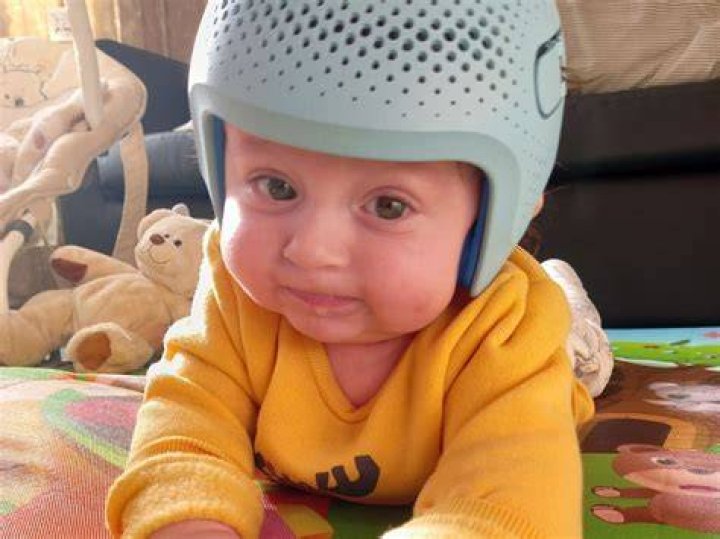 Why Do Babies Have To Wear A Helmet