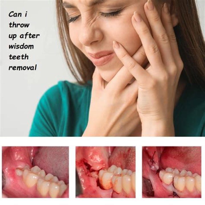 Why Do People Act Weird After Wisdom Teeth Removal