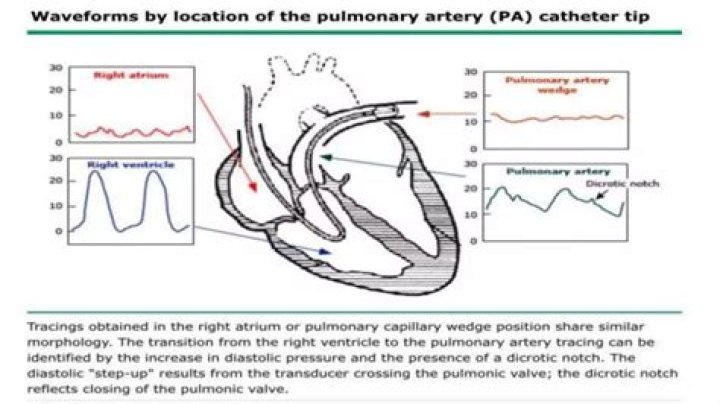 Why is pulmonary angiography done